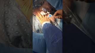 TECHNIQUE OF SUBCLAVIAN LINE AND TRIPLE LUMEN CATHETER INSERTION WITH ULTRASOUND GUIDANCE [upl. by Adehsar]