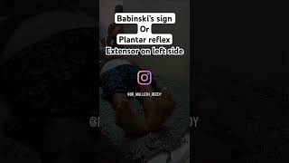 Babinski’s sign or Plantar reflex babinski’s sign plantarreflex neurology reflexes [upl. by Janette]