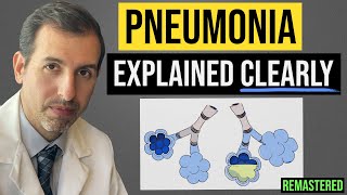 Pneumonia Explained Symptoms Diagnosis Labs Treatment [upl. by Schroth422]