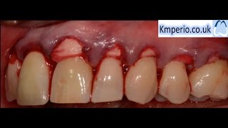 Alloderm Periodontal Surgery for Gum RecessionGraftingRoot CoverageUpper Teeth [upl. by Nosiddam582]