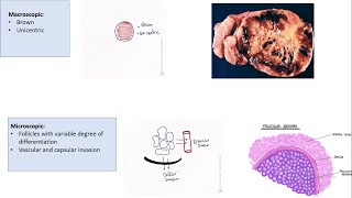 Thyroid Follicular carcinoma  Etiology  Presentation Mico and Macroscopic picture” [upl. by Felske]