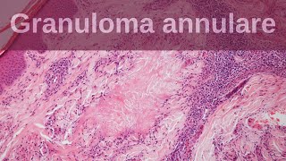 Granuloma Annulare  Pathology mini tutorials [upl. by Demb171]