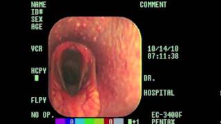 Laryngeal Hemiplegia Explained m4v [upl. by Annayram22]