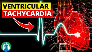 Ventricular Tachycardia Vtach  Medical Explainer Video [upl. by Sontich]