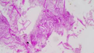 Mucormycosis under the microscope with Haematoxylin and Eosin HampE stain [upl. by Yerxa]