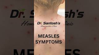 Symptoms of measles Measles MeaslesRash FeverAndRash Call us93500240339871517244 [upl. by Rostand]