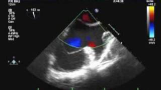 Transesophageal Echocardiogram TEE part2 [upl. by Ynnej711]