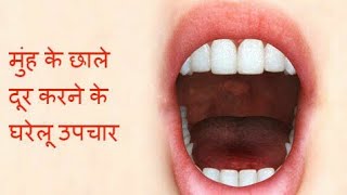 1 घंटे में मुंह और जीभ के छाले ठीक करने के लिए घरेलु उपाय  Home Remedy for Mouth amp Tongue Ulcers [upl. by Lerraj276]