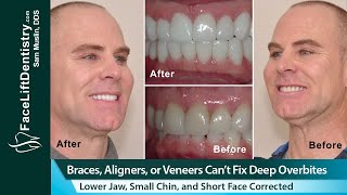 Braces Aligners or Veneers Can’t Fix a Deep Overbites Short Face and Weak Chin [upl. by Katt]