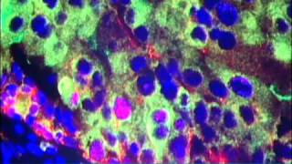 Nanoparticles for Cancer Treatment Video  Brigham and Womens Hospital [upl. by Stanwood]