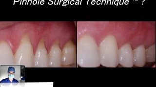 What is the Pinhole Surgical Technique® a SurgicalMaster™ QuickLecture [upl. by Aivekahs]