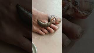 LEECH THERAPY IN DIABETIC ULCER REWAAYURVEDA [upl. by Etyam384]