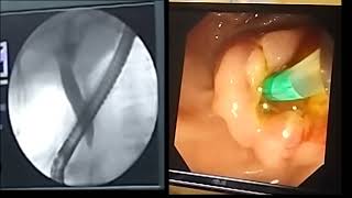 ERCP Metallic Stent Placement BDENDOSCOPY [upl. by Abramson]