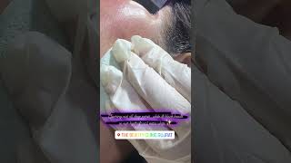 Hydrafacial cleaning out blackampwhite heads skincare beautyclinic beauty hydrafacial [upl. by Innis]