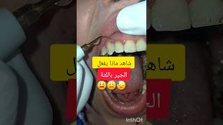 جير الاسنان سبب التهاب لثة شديد dentist stitch اكسبلور stitchfan ترند stitchlover dentistry [upl. by Yasu616]