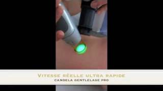 Epilation des jambes au laser [upl. by Drabeck449]