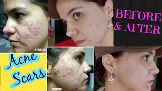 How to get rid of ACNE SCARS microdermabrasion [upl. by Anizor]