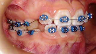 ¿Se puede colocar brackets en dientes de leche 😎🤯 En pacientes jóvenes👀 [upl. by Kinimod27]