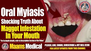 Oral Myiasis  Shocking Truth About Maggot Infestation In Your Mouth  Maams [upl. by Seth283]