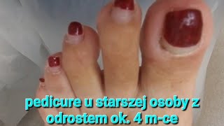 pedicure u seniora z odrostem ok 4mce podologia podopogotowie podology [upl. by Manuel]