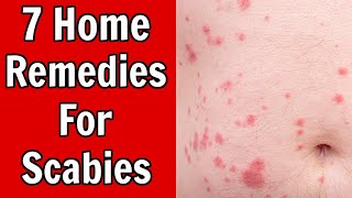 7 Home Remedies For Scabies [upl. by Rutledge861]