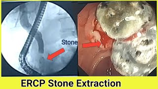 CBD Stone Extraction BDENDOSCOPY [upl. by Luckett768]