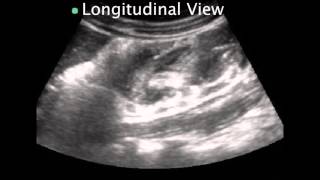 Pediatric Intussusception [upl. by Yesdnil771]