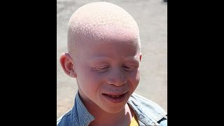 Albinism Causes Diagnosis and Treatment [upl. by Reynard]