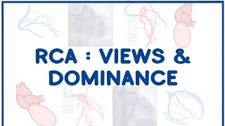 Right Coronary Artery Angiogram Views amp Dominance [upl. by Airet]