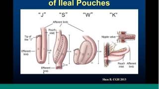 HealthPROMISE Webinar Series Pouchitis and IBD  October 2016 [upl. by Horter]