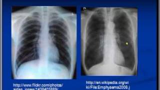 Chest xray interpretation COPD and Emphysema [upl. by Elisa]