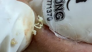 Acne Treatment Huong Da Nang  2024 Acne Huong 713 [upl. by Soisanahta52]