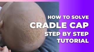 How to Get Rid of Cradle Cap StepbyStep Guide [upl. by Llennaj]