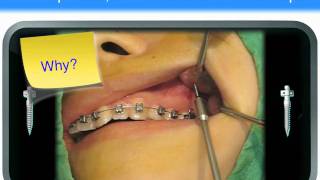 OBS Tips 4 Screw fracture [upl. by Harelda]