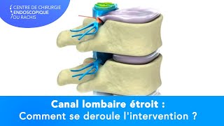 CANAL LOMBAIRE ÉTROIT  Comment se déroule lintervention [upl. by Pokorny]