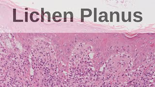 Lichen Planus  Pathology mini tutorial [upl. by Yenttirb]