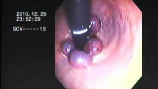 haemorrhoid banding BY DR NASEEM GHOURI [upl. by Edlihtam]