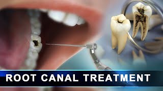 Root Canal Treatment step by step  Curveia Dental Animation in 3D  Endodontics for tooth decay [upl. by Auohp807]