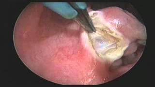 ENT Tonsillectomy with QMR Vesalius Device [upl. by Kendall]