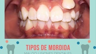 BRACKETS  Tipos de Mordida ¿Cómo saber si necesito Ortodoncia [upl. by Sirraf]