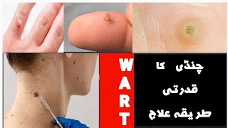 SKIN TAG AND SKIN سکن ٹیگ اور سکن واٹ اور اس کا علاج [upl. by Naginnarb]