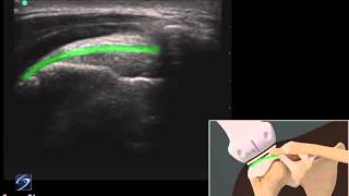 3D Lehrvideo Ultraschalluntersuchung beim akromialen Impingementsyndrom der Schulter  SonoSite [upl. by Clevey]