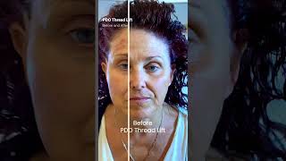 PDO Thread Lift Before and After Nonsurgical Facelift PCH MedSpa Newport Beach [upl. by Kilah]