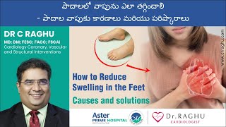 Causes of feet swelling  Treatment for swelling feet  Dr Raghu  Cardiologist [upl. by Domonic]