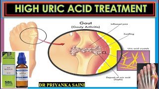 Hyperuricemia  High uric acid level in blood  HOMEOPATHY TREATMENT drpriyankashomeopathy [upl. by Lowenstern]