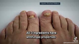 Natural Remedy for Fungus Nail Infection [upl. by Narrad]