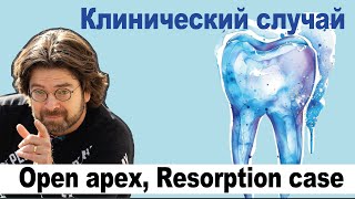 Клинический случай Open apex Resorption case [upl. by Raamal]