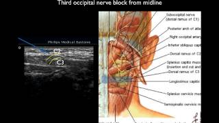 Ultrasound guided thrid occipital nerve block [upl. by Buine186]