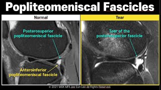 Anatomy17 Tear of posterosuperior Popliteomeniscal fascicle [upl. by Ermentrude493]