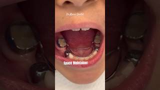 Bilateral Space maintainer braces viral orthodontist youtubeshorts dentist braces trending [upl. by Latvina]